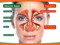 Sinus-Infection.jpg