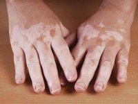 06-eye-color-vitiligo-sl.jpg
