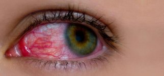 20-Effective-Home-Remedies-For-Sore-Eyes1.jpg
