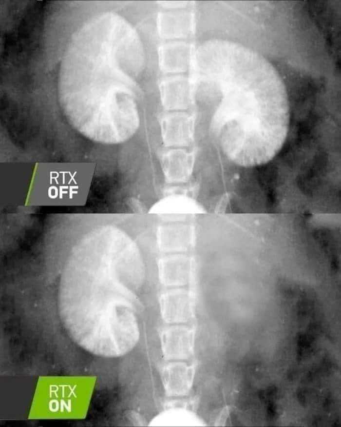 rtx=kidney.jpeg